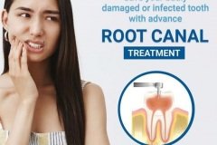 root-canal